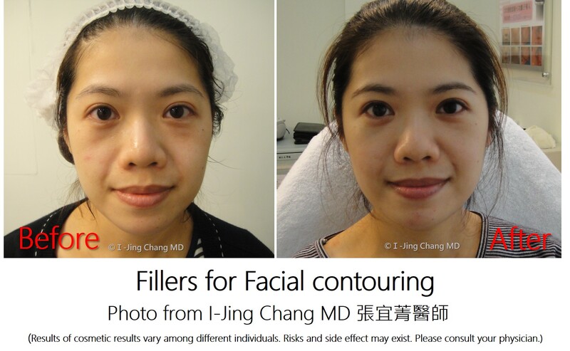 injection before and after