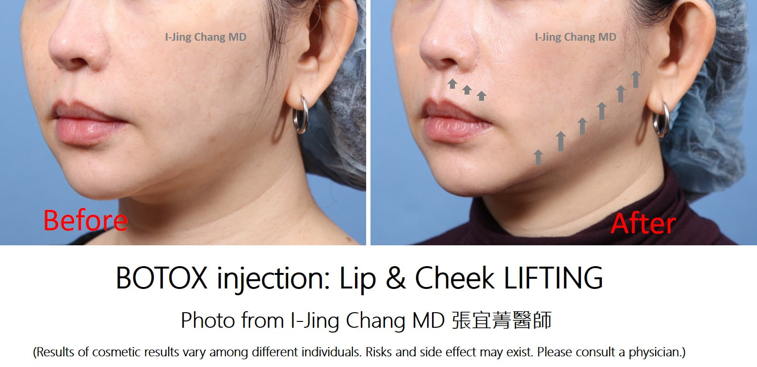 face and lip lift