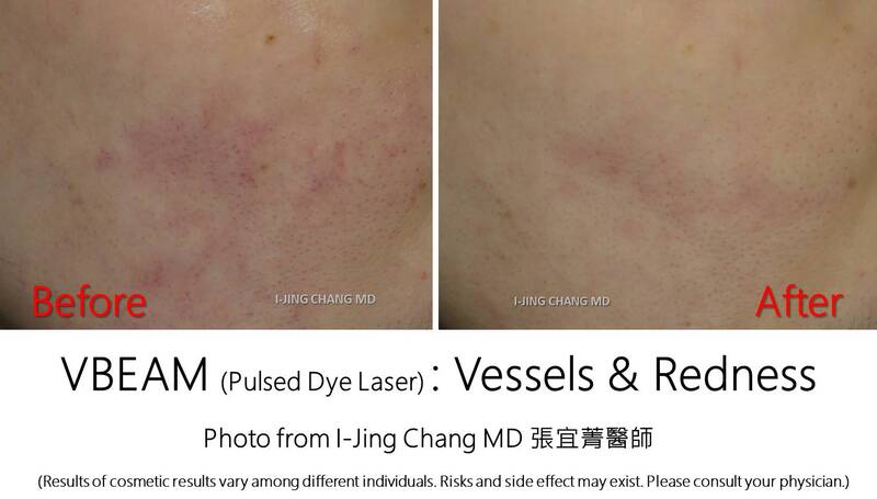 VBEAM before and after