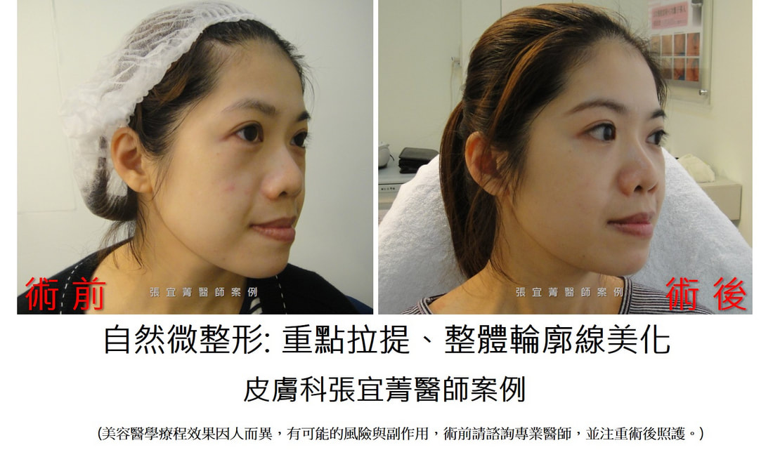 自然微整 美化輪廓線