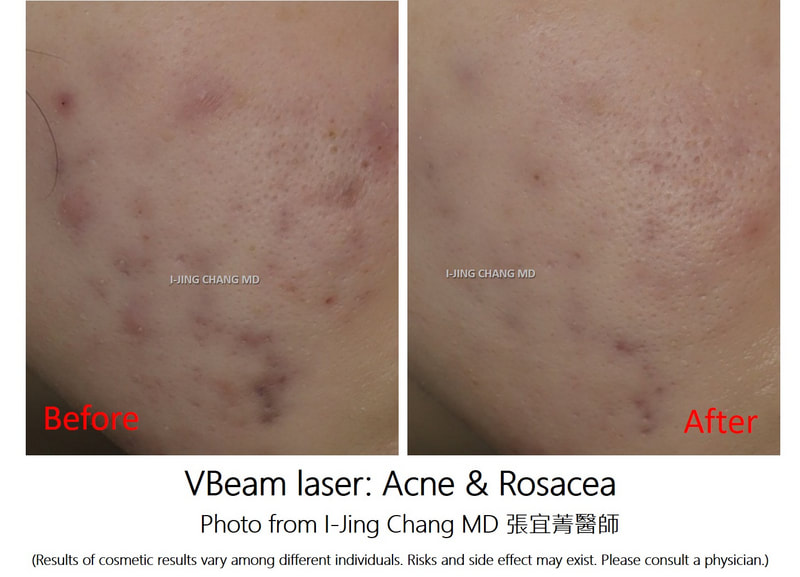 Acne and rosacea treatment