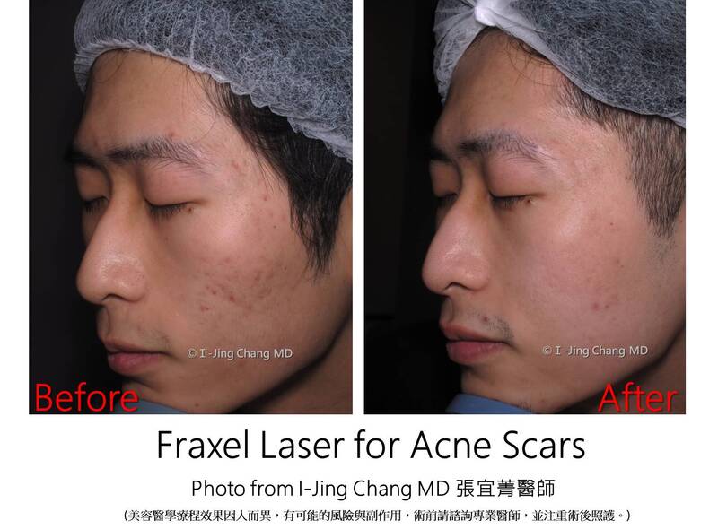 laser before and after
